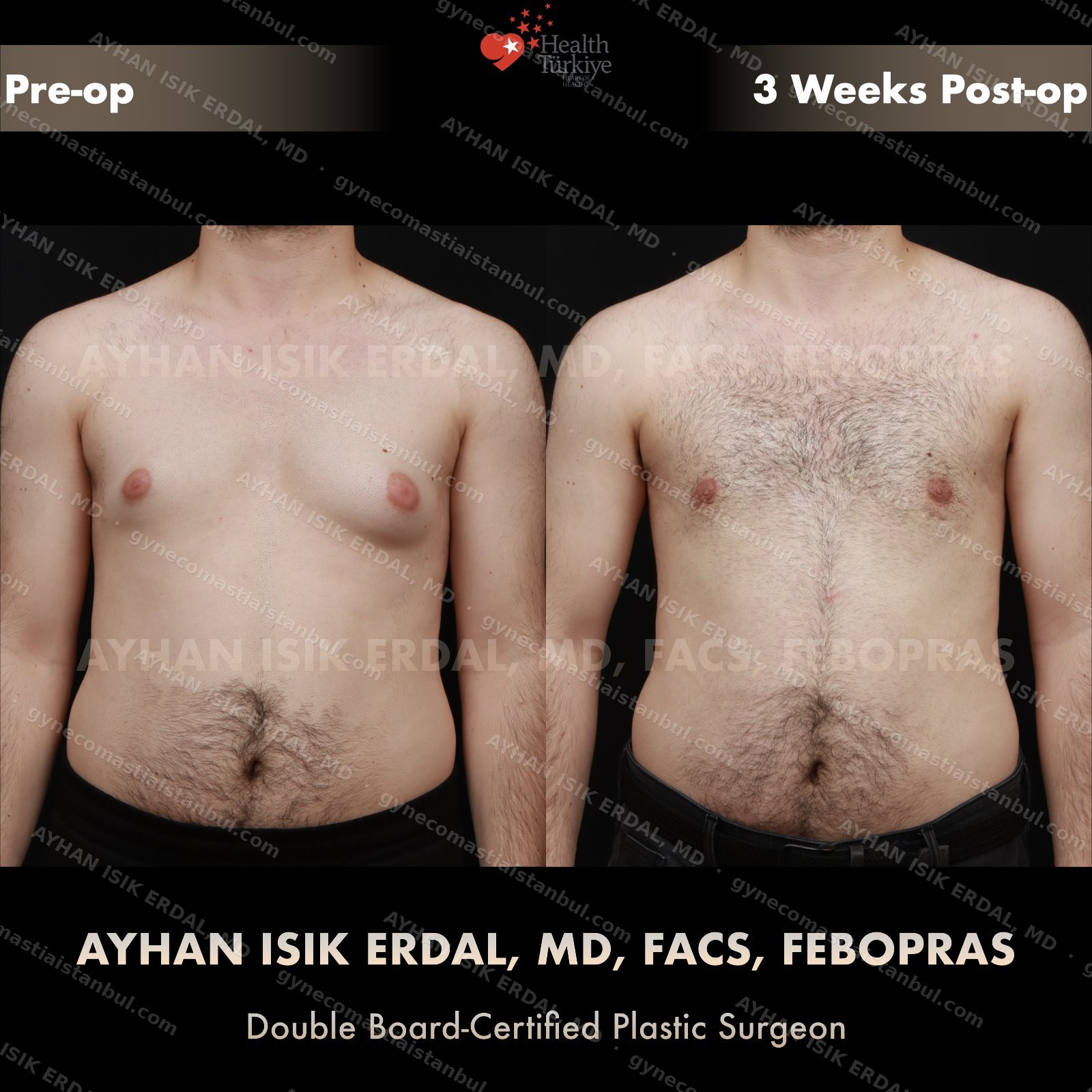 Gynecomastia before and after — frontal view, 3 weeks post-op