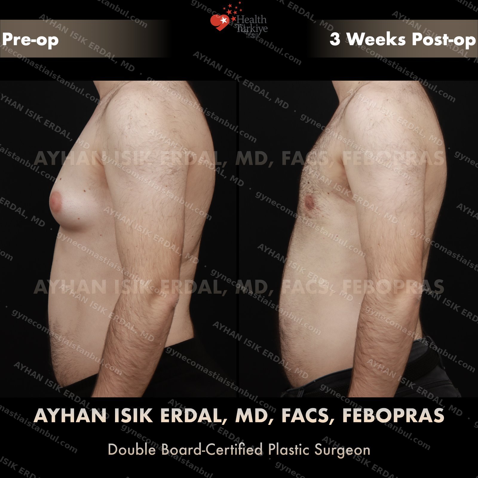 Gynecomastia before and after — oblique view, 3 weeks post-op