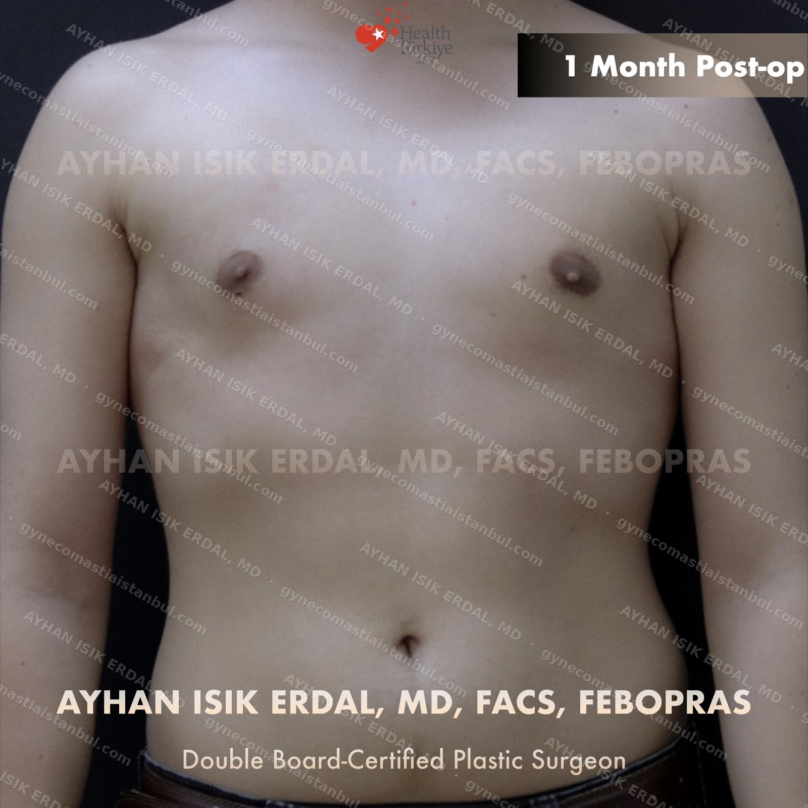Gynecomastia before and after — oblique view, 1 month post-op