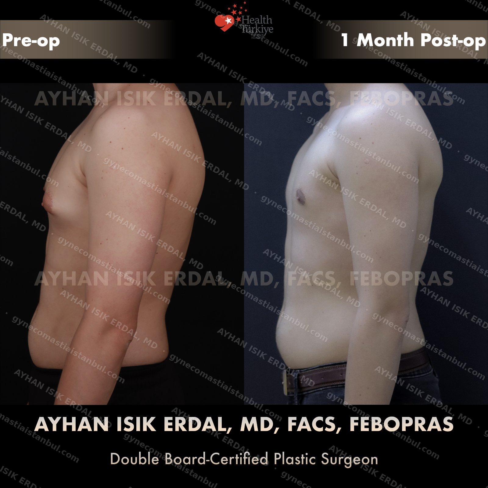 Gynecomastia before and after — posterior view, 1 month post-op