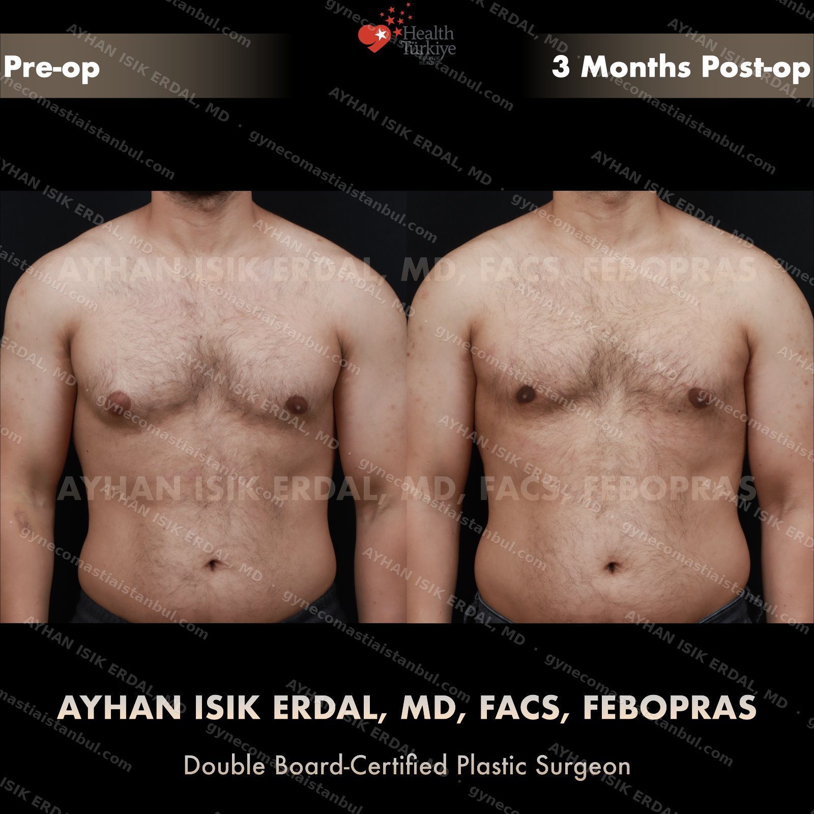 Gynecomastia before and after — frontal view, 3 months post-op